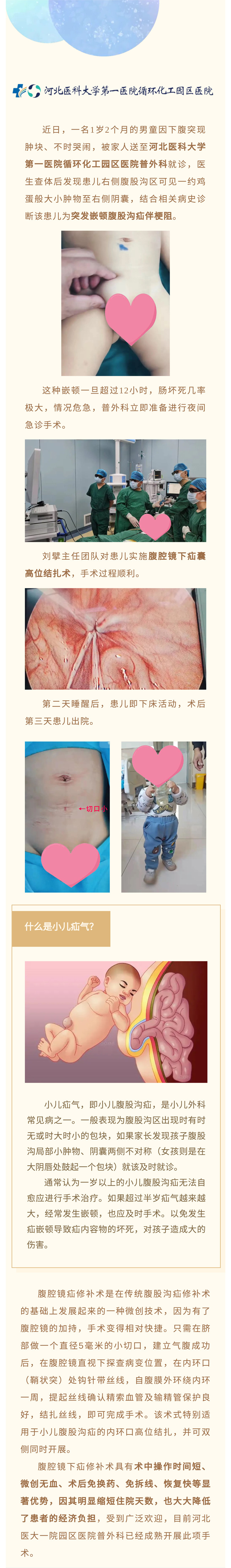 腹腔鏡微創(chuàng)手術(shù)治療小兒疝氣——切口5毫米！手術(shù)→活動(dòng)，僅半天！-1.jpg